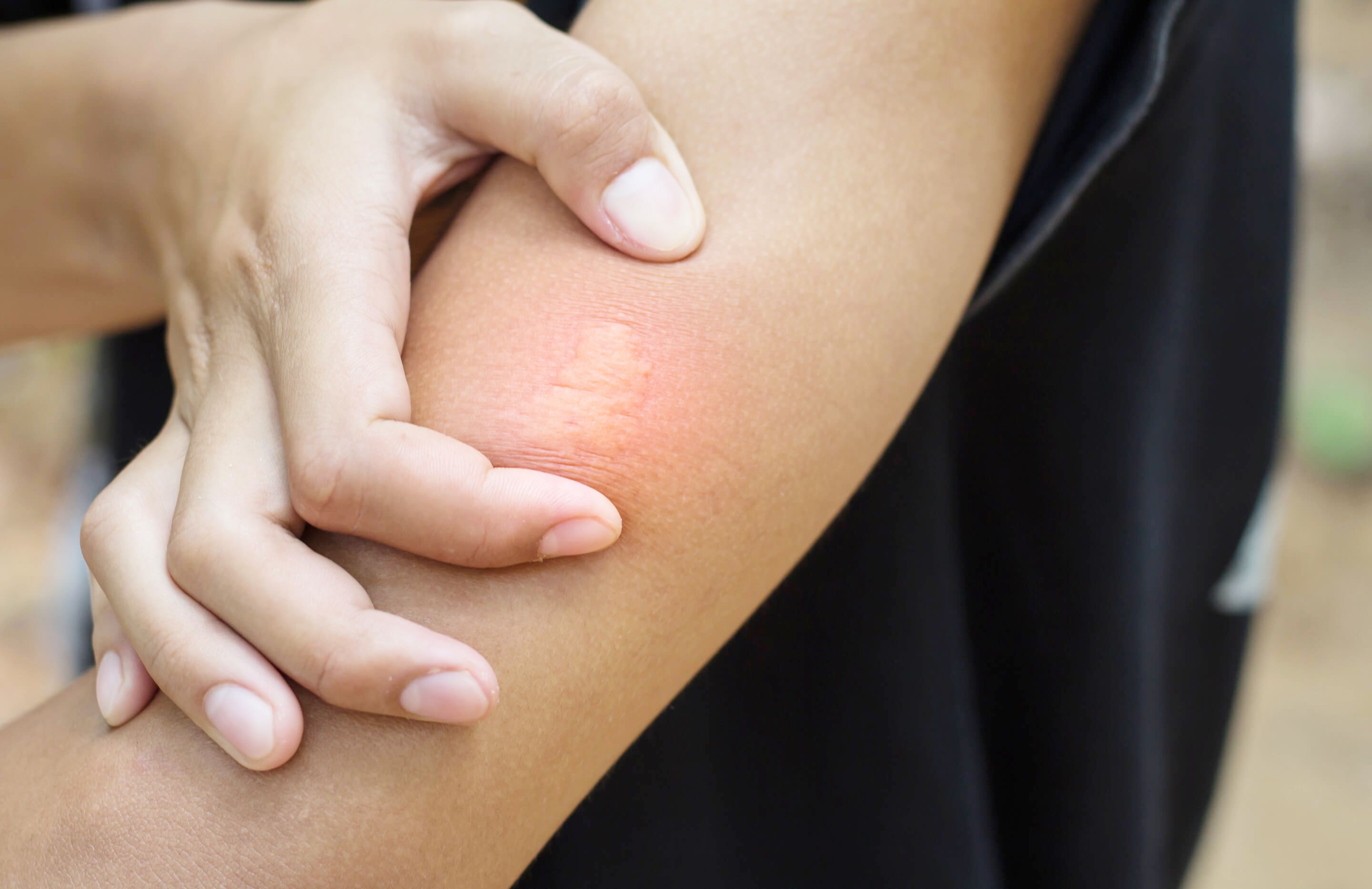 日焼け床かぶれの症状は何ですか?