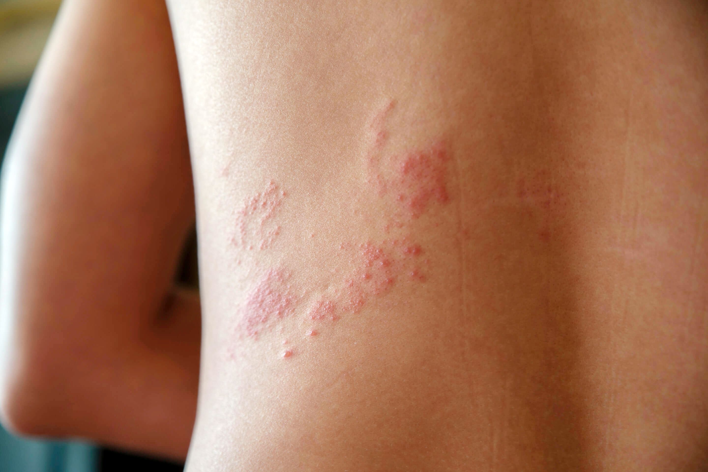 軽度の帯状疱疹はどれくらい続くのでしょうか？